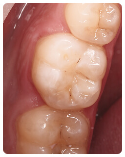 Лечение кариеса в Луганске, стоматология Дент-Арт