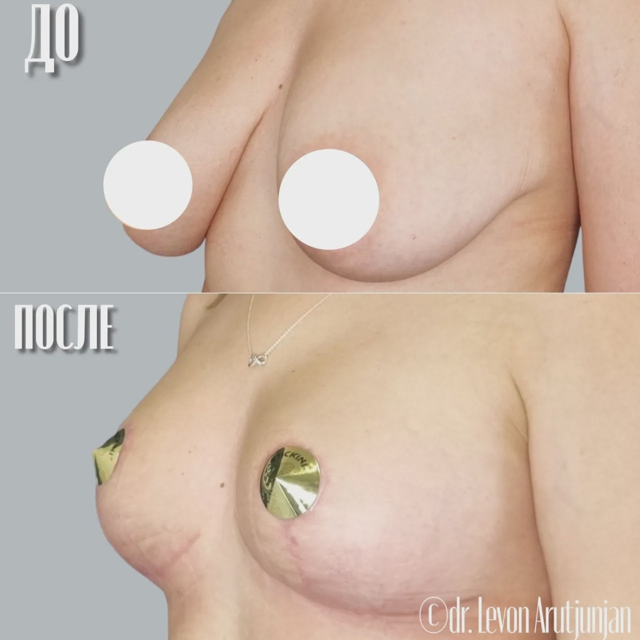 отзывы женщин о подтяжке груди фото 93