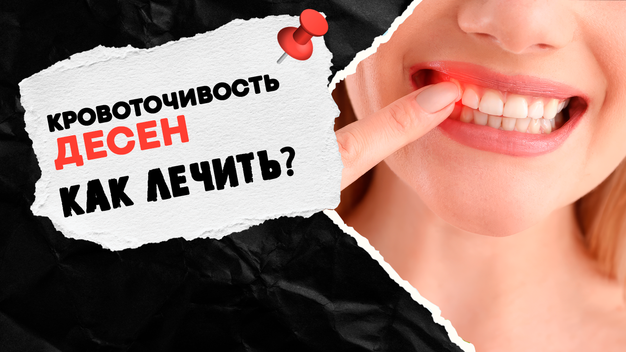 Кровоточивость десен при чистке зубов