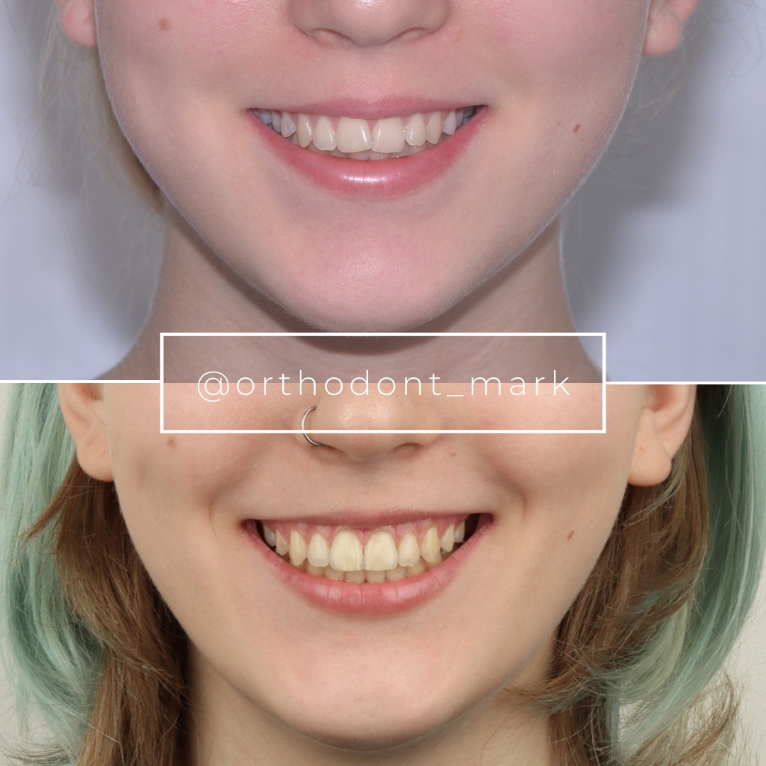 Before treatment: Class II bite with spacing between the upper incisors — photo 1 of 7