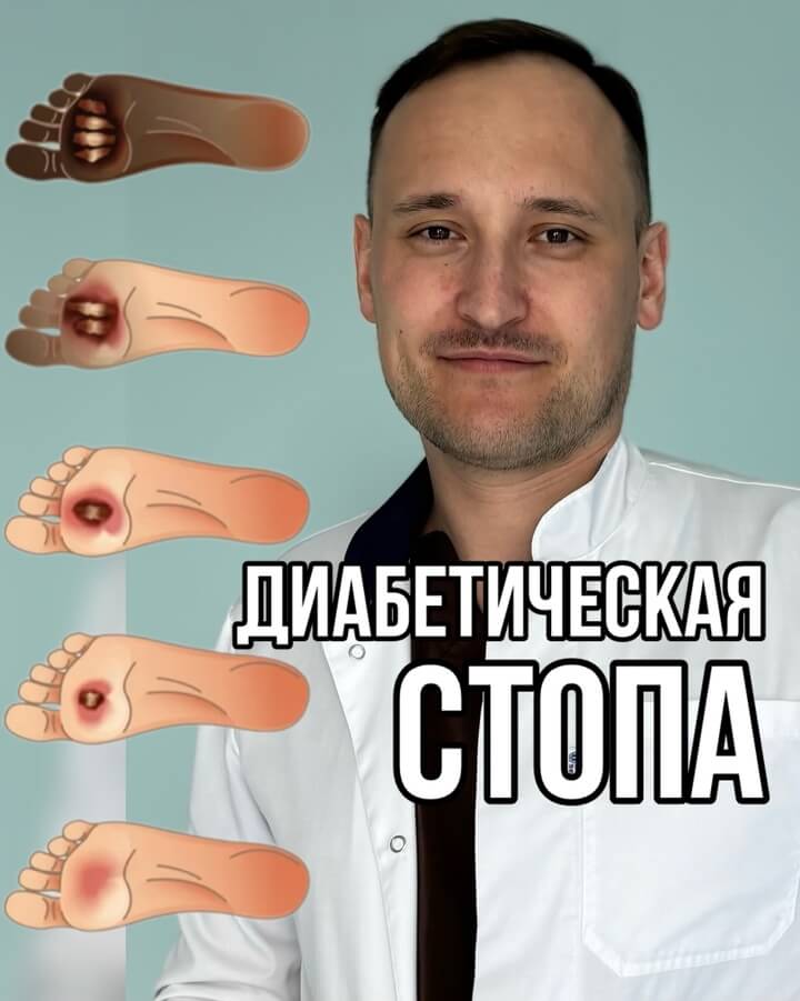 Диабетическая стопа