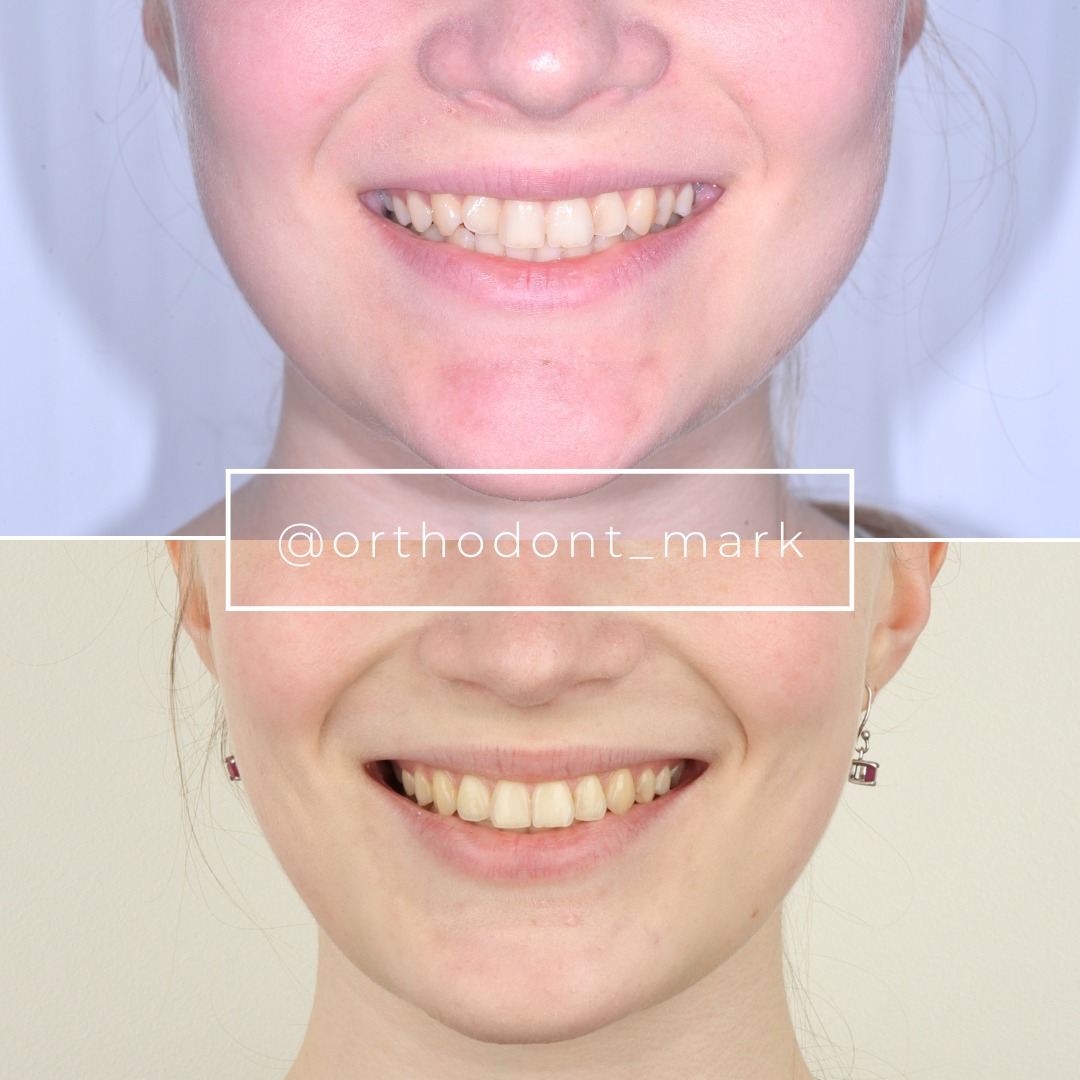 Correcting Mild Crowding and Deep Bite With Damon Braces