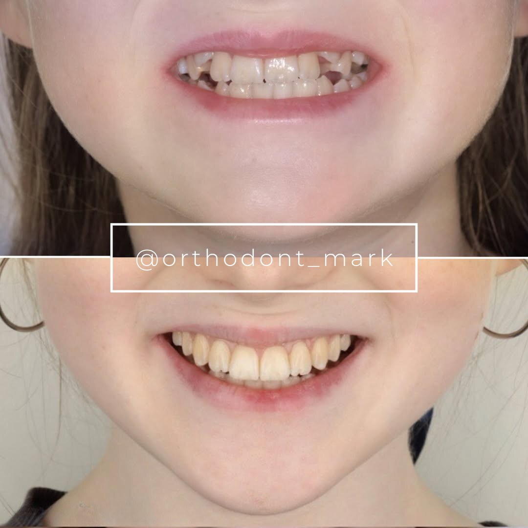 Before treatment view showing severe crowding and an edge-to-edge anterior bite — photo 1 of 3