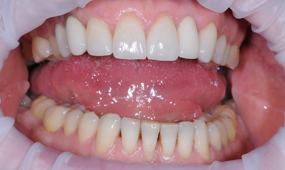 Удаление пигментированного зубного налета методом Air Flow