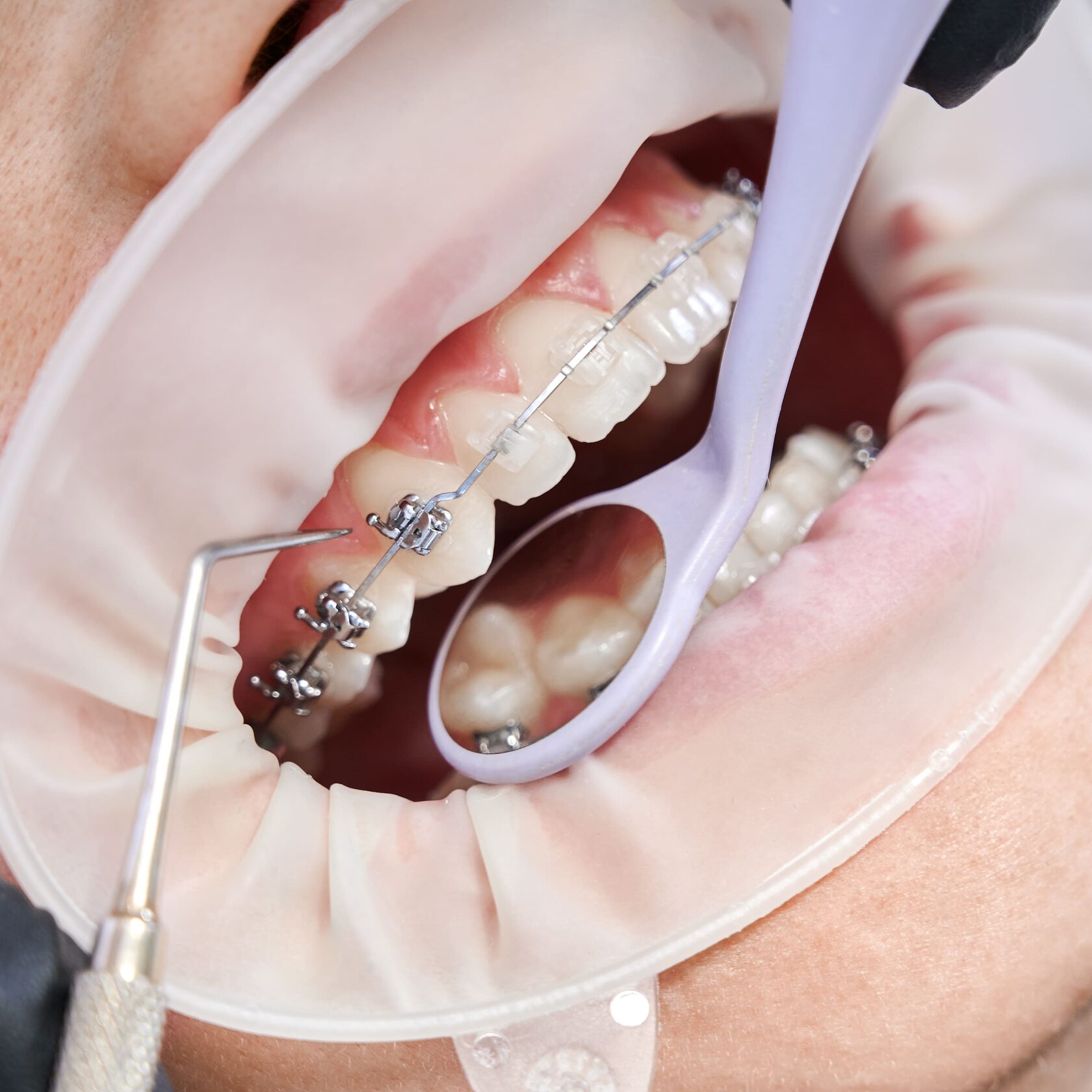 фото имплантов жевательных зубов