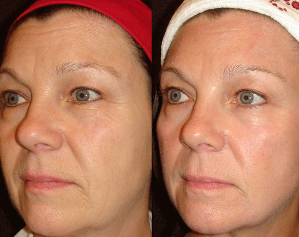 Результаты Элос омоложения в Кирове