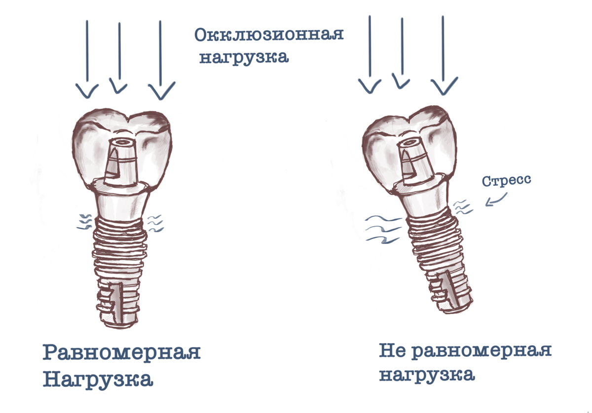 Как делается имплантация зубов на схеме покажите