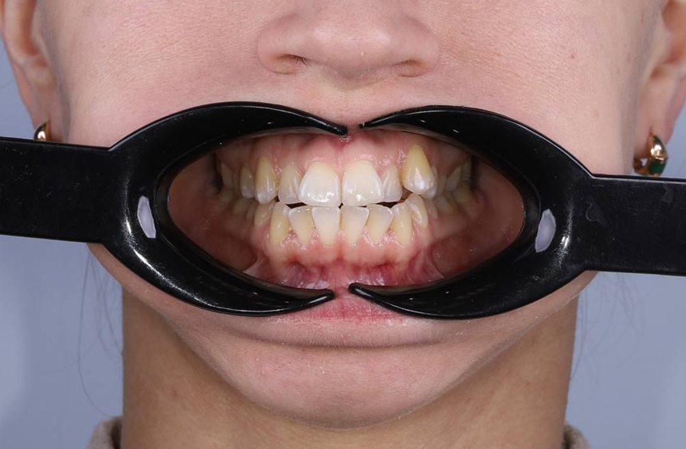 Восстановление правильной окклюзии и ровного зубного ряда брекетами Даймон Q2