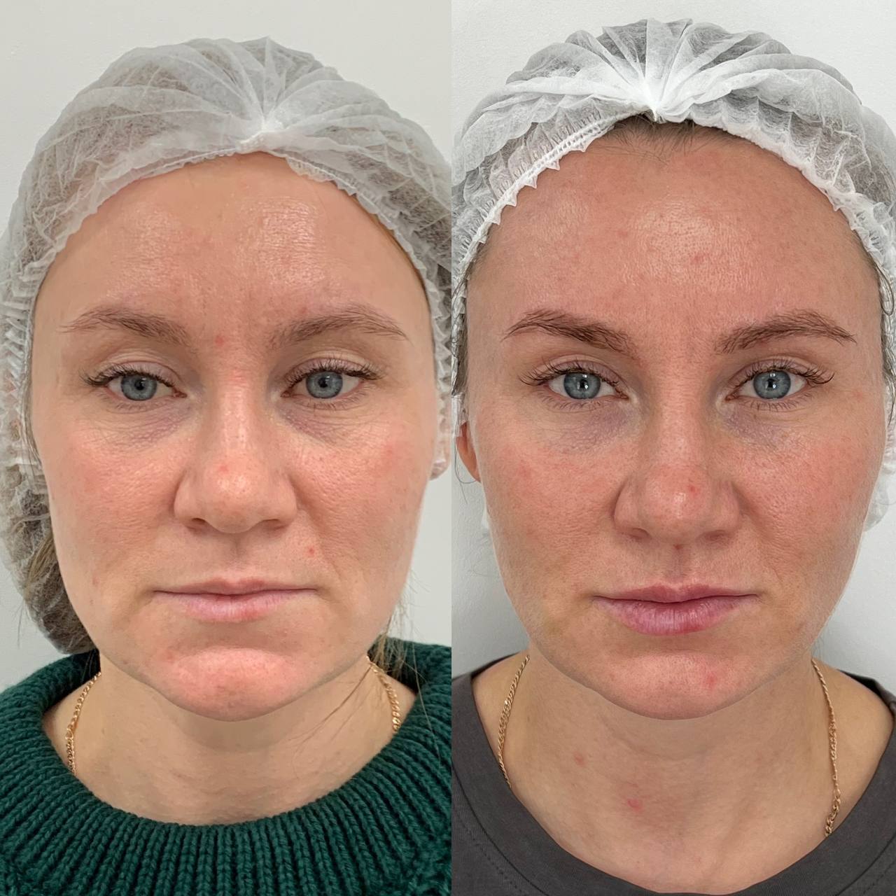 пациентка 38 лет. пациентка 38 лет. эндокринологическое отделение лежит пациентка задач. массаж от нависшего верхнего века. пациентка 38 лет.