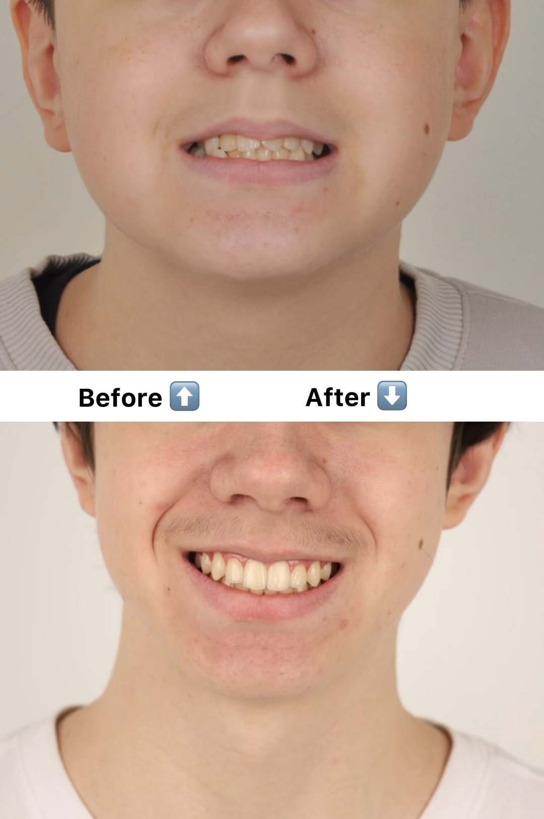 Before and after comparison showing a stable, long-term retained orthodontic result