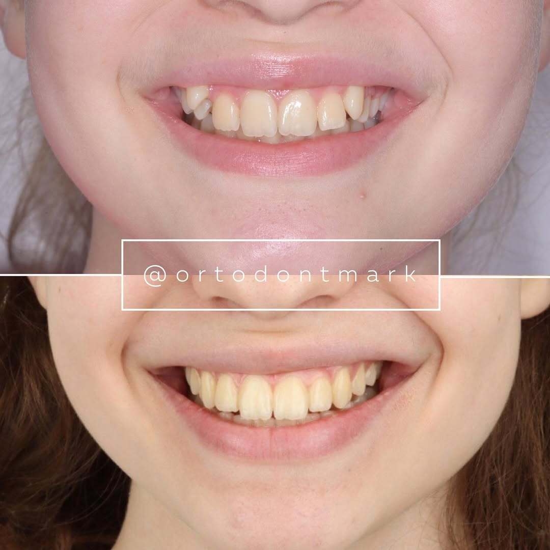 Crowding and Canine Supraposition Corrected to a Symmetrical Smile