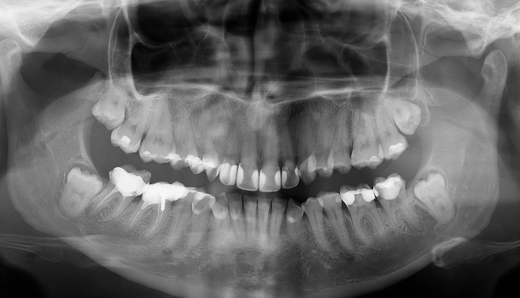 Снимок зубов видное. Ортопантомограмма кариес. Снимок пульпита рентген зуба. Глубокий кариес рентген.