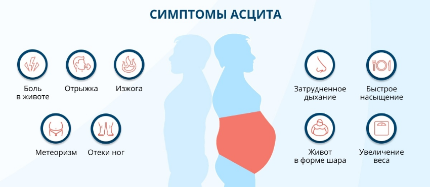 Асцит при онкологии, циррозе: причины, лечение