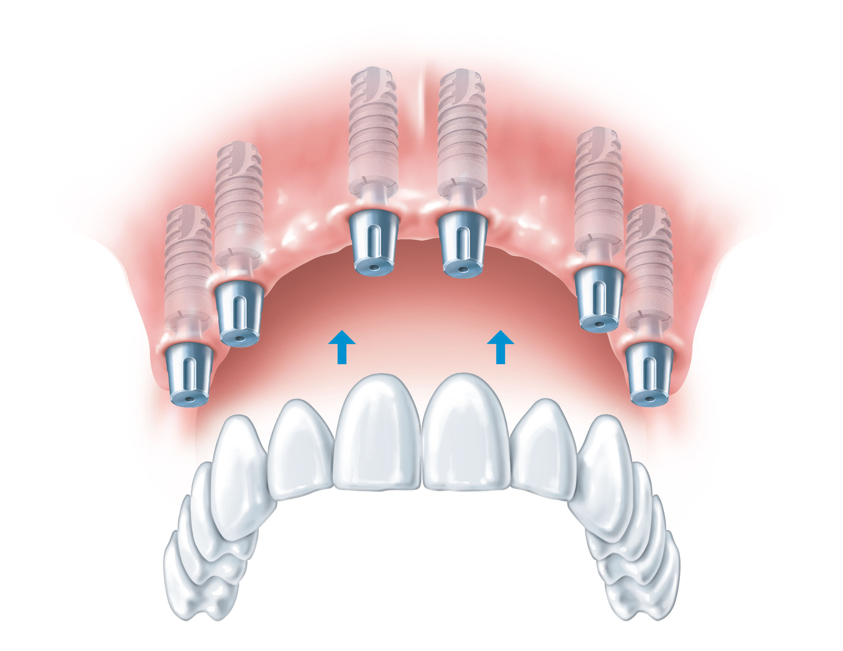 Имплантация зубов all on 6. Имплантация зубов на 6 имплантах верхней челюсти. Несъемный протез на 6 имплантах. Протез на 6 имплантах на верхнюю челюсть. Имплантация верхней челюсти на 6 имплантах схема.