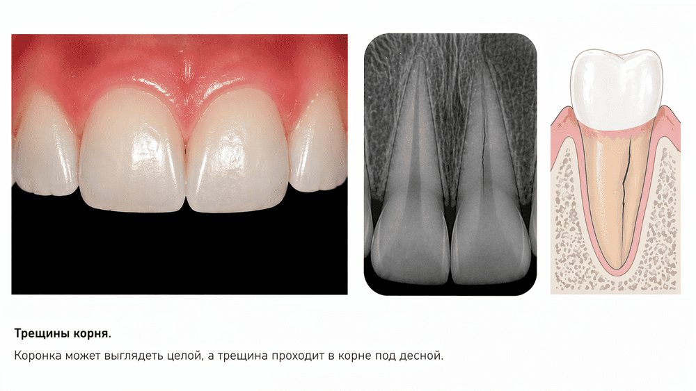 Трещина корня переднего зуба