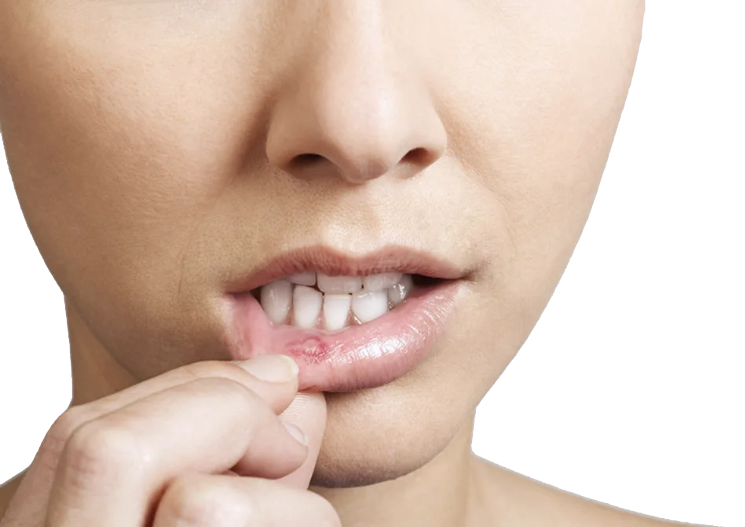 Стоматологический справочник: Афта во рту - Стоматология 