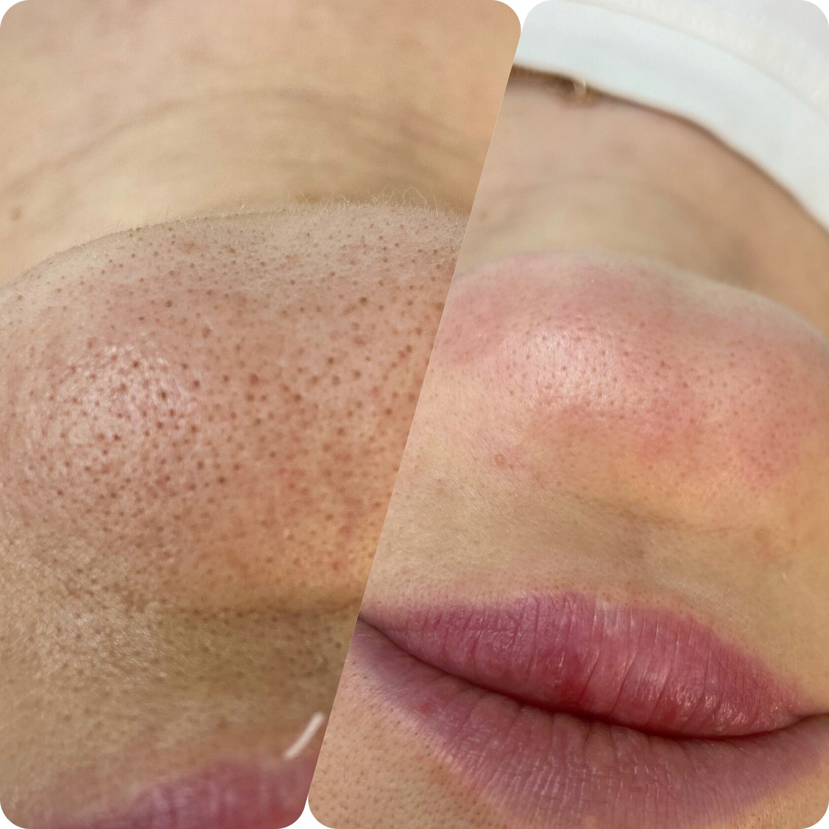 ДО/ПОСЛЕ ЭСТЕТИЧЕСКИХ ПРОЦЕДУР