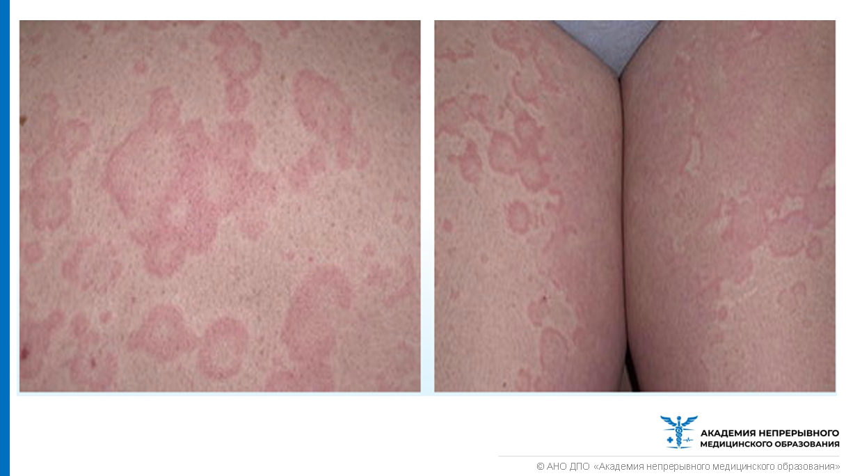Как бороться с аллергией на клещей домашней пыли? Отвечает специалист.