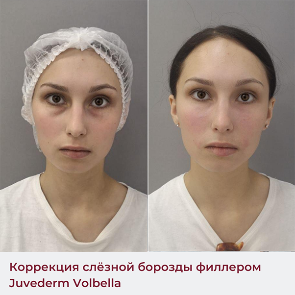 Носослезная борозда отзывы до и после коррекция Косметолог-эстет Магнитогорск ВКонтакте