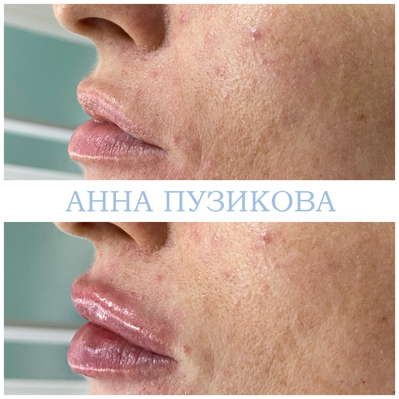 Контурная пластика губ гиалуроновым филлером — естественный результат без утраты пропорций. Косметолог Пузикова Анна Анатольевна, Санкт-Петербург.