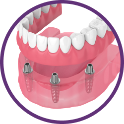Установка имплантов в Дербенте. Имплантация при отсутствии одного зуба.