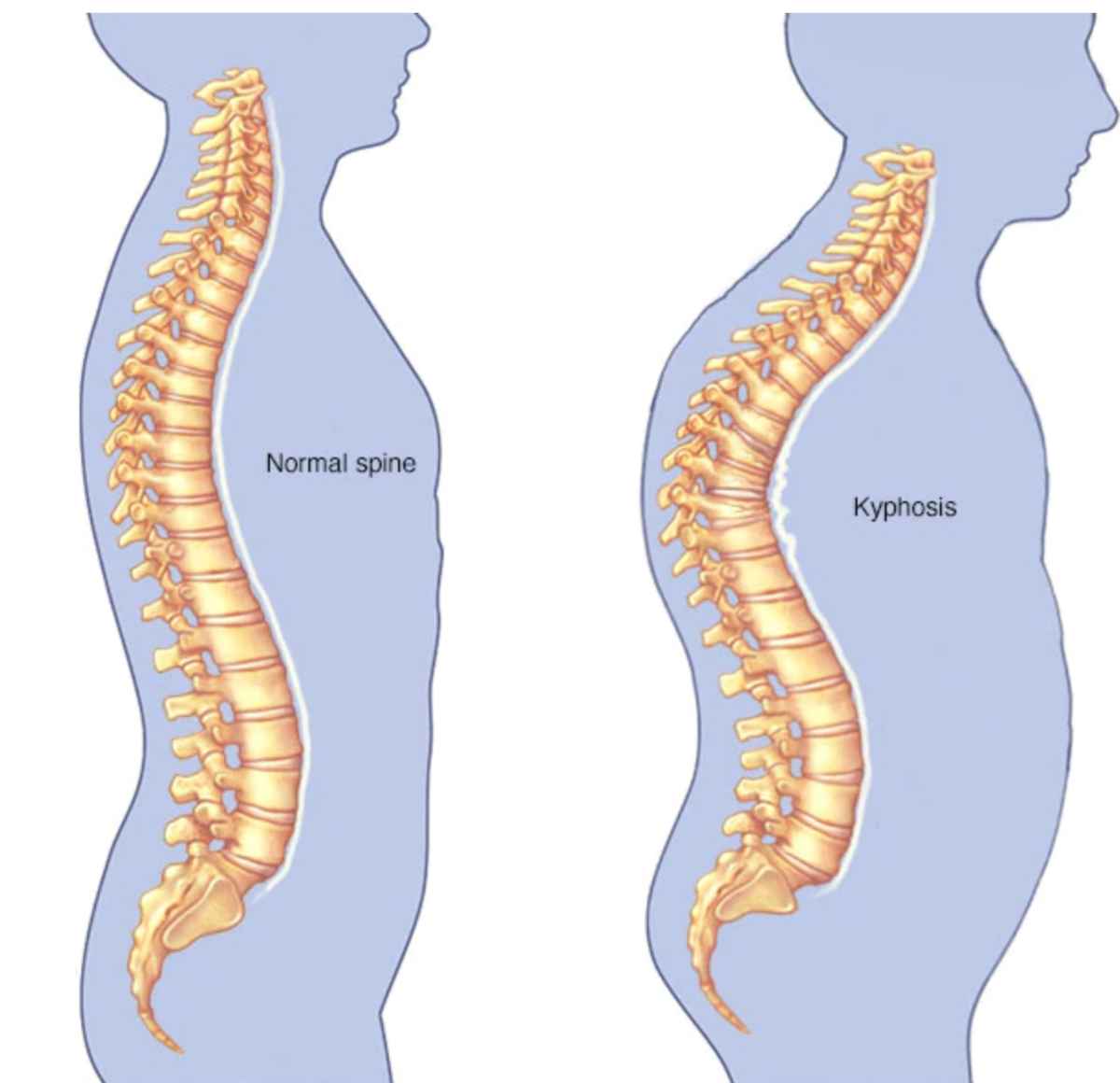 Что такое кифоз и как его вылечить?
