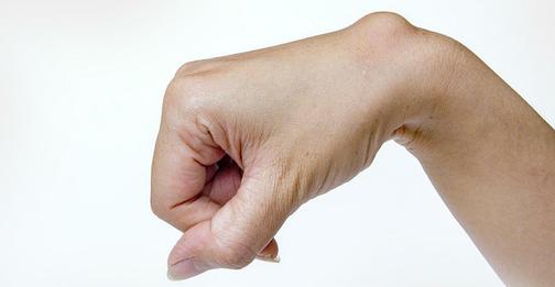 Симптомы гигромы и как получить помощь | Диагностирование и лечение ...