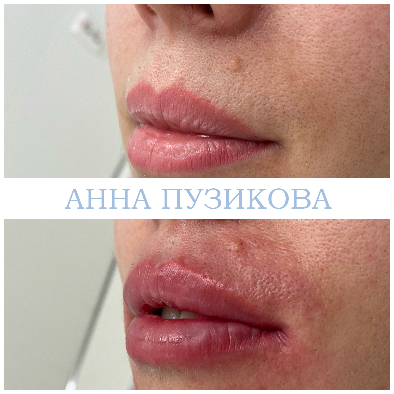 Фото до и после процедуры контурной пластики губ. Естественный результат после коррекции у косметолога Пузиковой Анны Анатольевны, клиника Прадус СПб.
