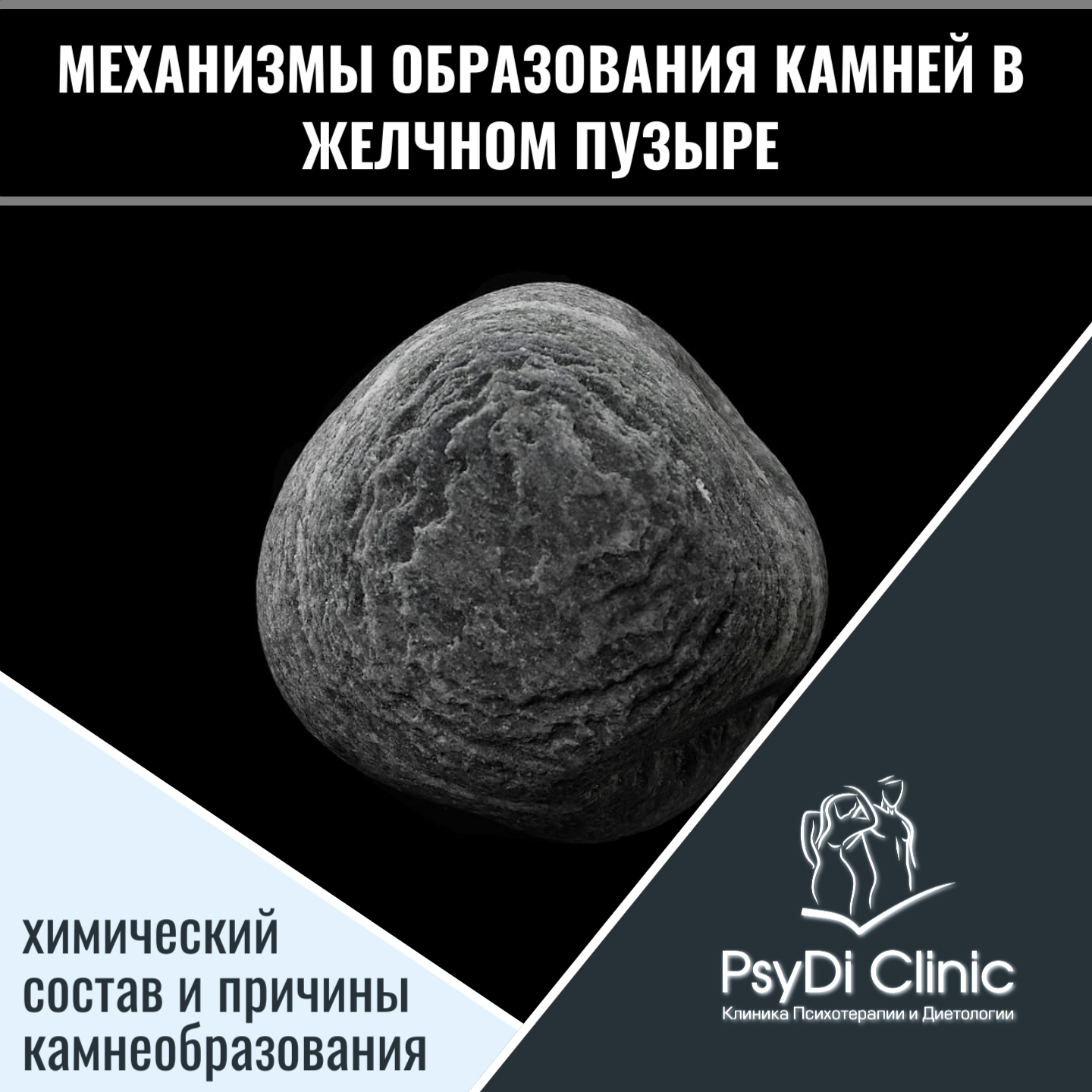 Механизмы образования камней в желчном пузыре: химический состав и причины камнеобразования ��