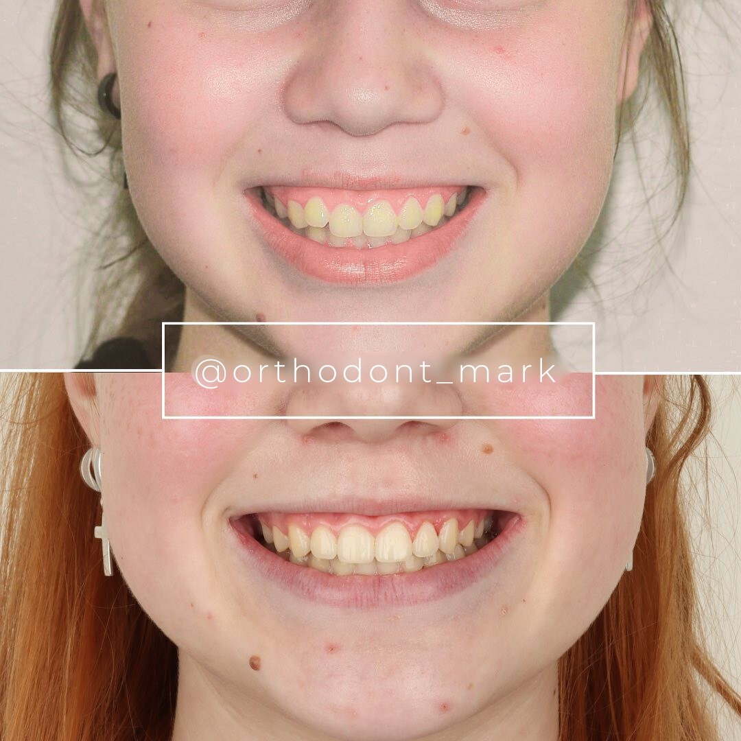 Correcting Narrow Arches, Asymmetry, and Midline Shift