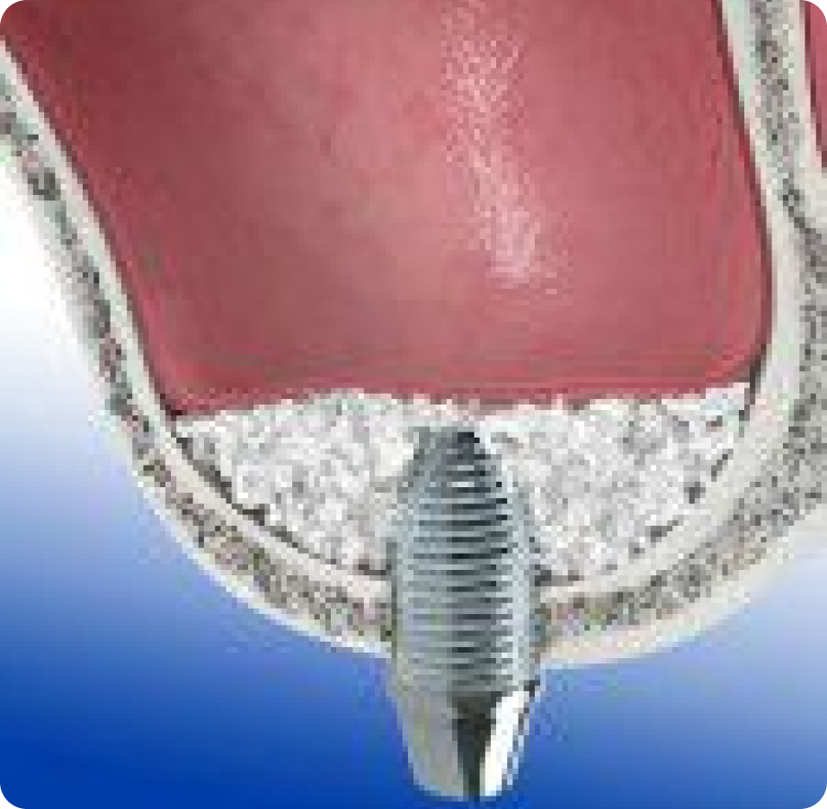 Синус лифтинг екатеринбург. Открытый синус лифтинг. Синус лифтинг и имплантация. Титановая сетка синуслифтинг. Синус лифтинг доктор лянг.