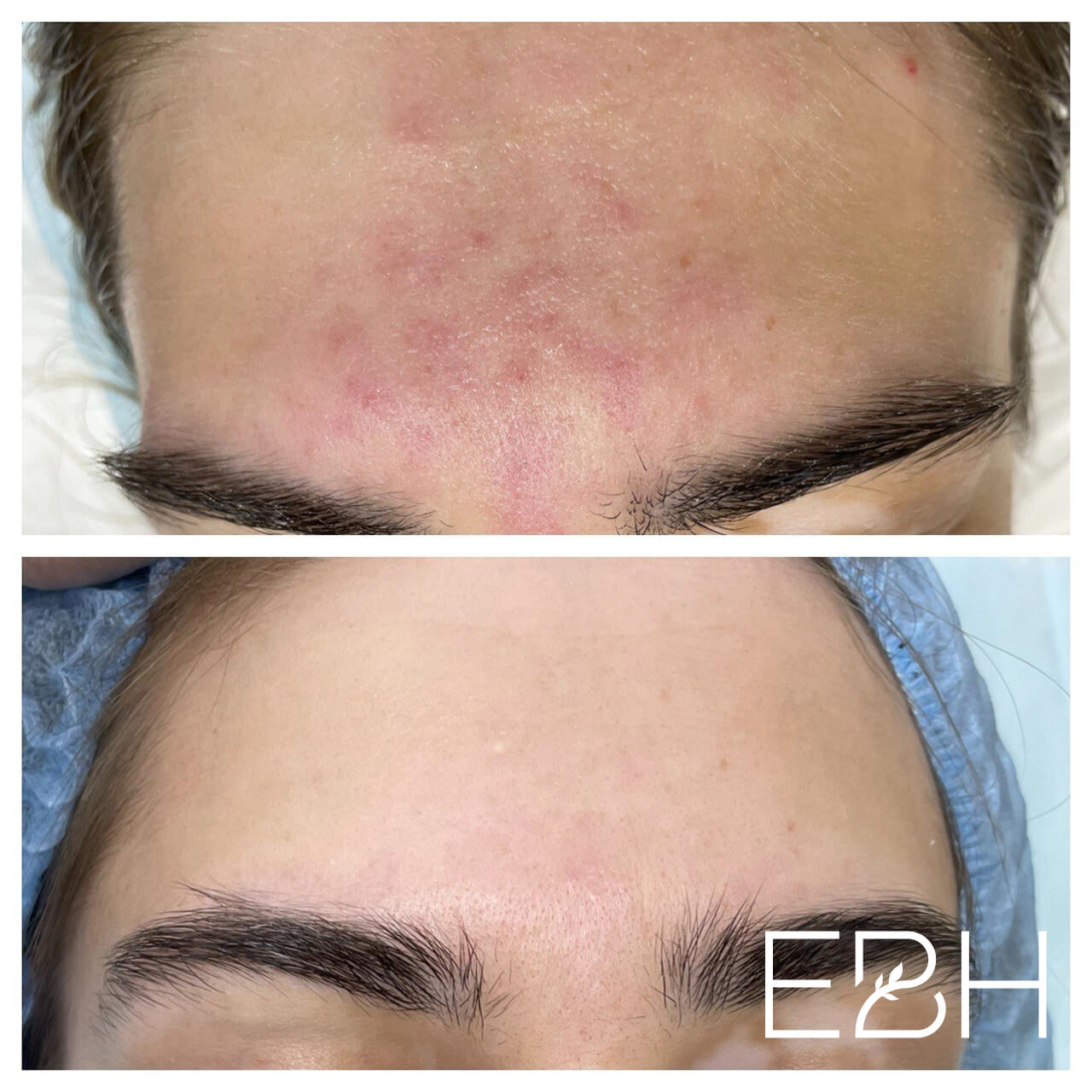 комплексное лечение акне в москве