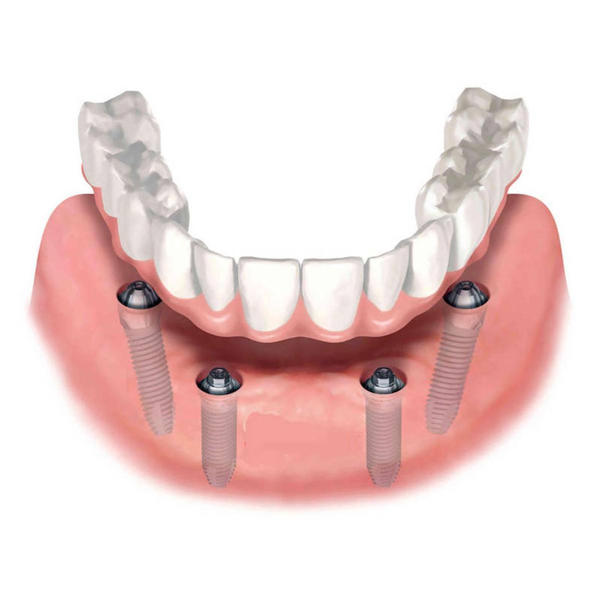 Имплантация зубов all on 6. Консольный мостовидный протез на имплантах. Пластиночный съемный протез на имплантах. Имплантация челюсти на 6 имплантах. Несъемный протез на 4 имплантах.