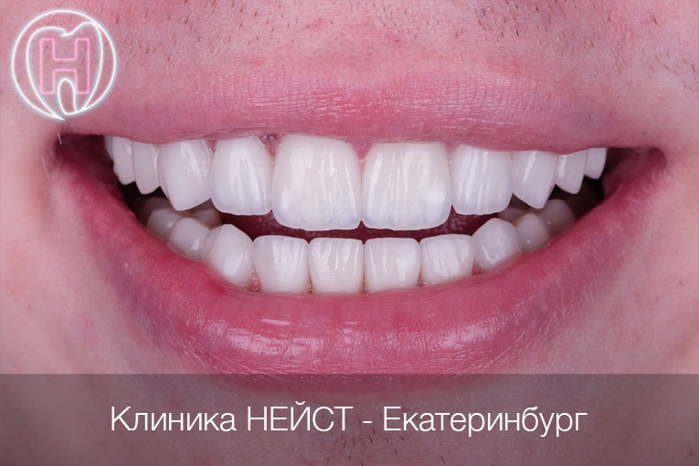 мужские керамические виниры цвет Блич 3 (Bleach3)