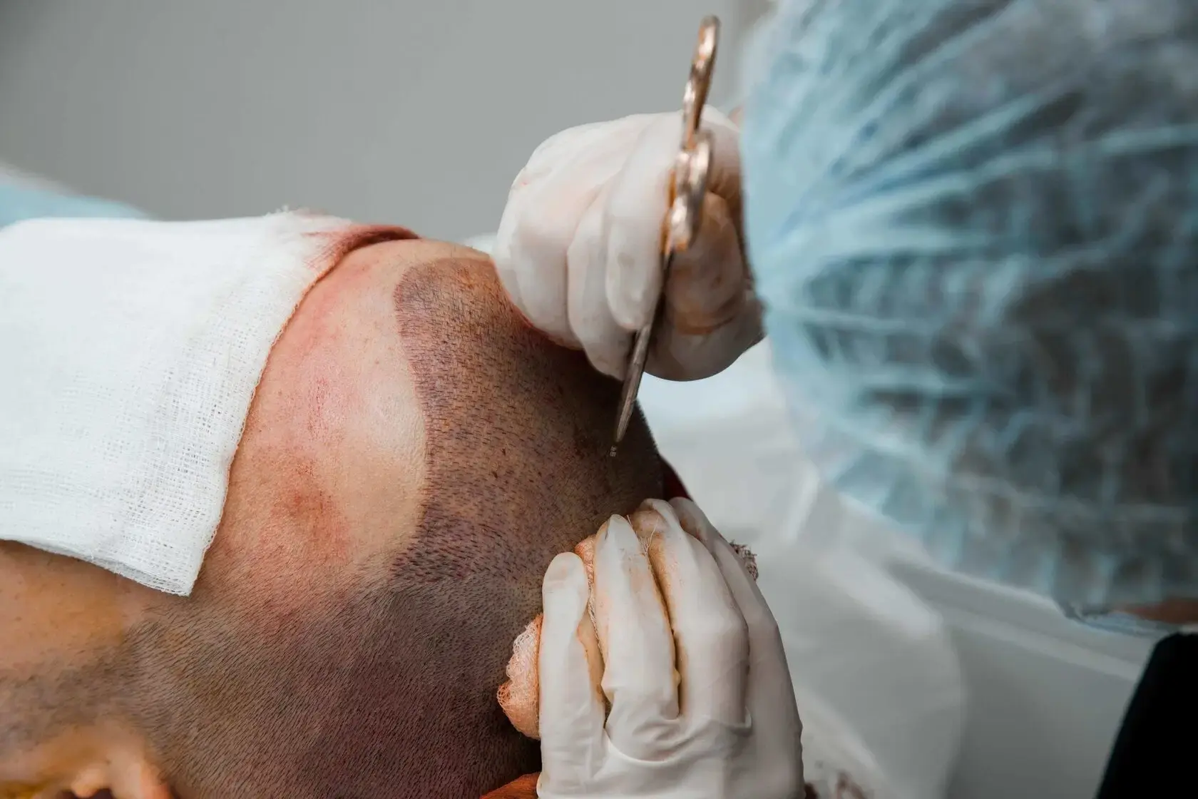 Пересадка волос методом ФУЕ