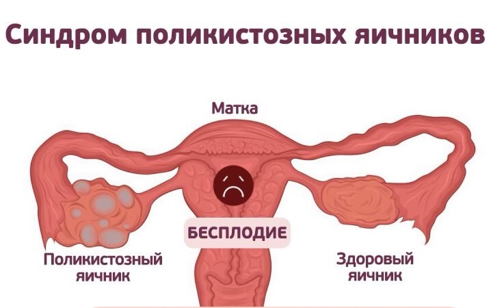 Болят Яичники После Секса У Женщин Болят Яичники После Секса У Женщин