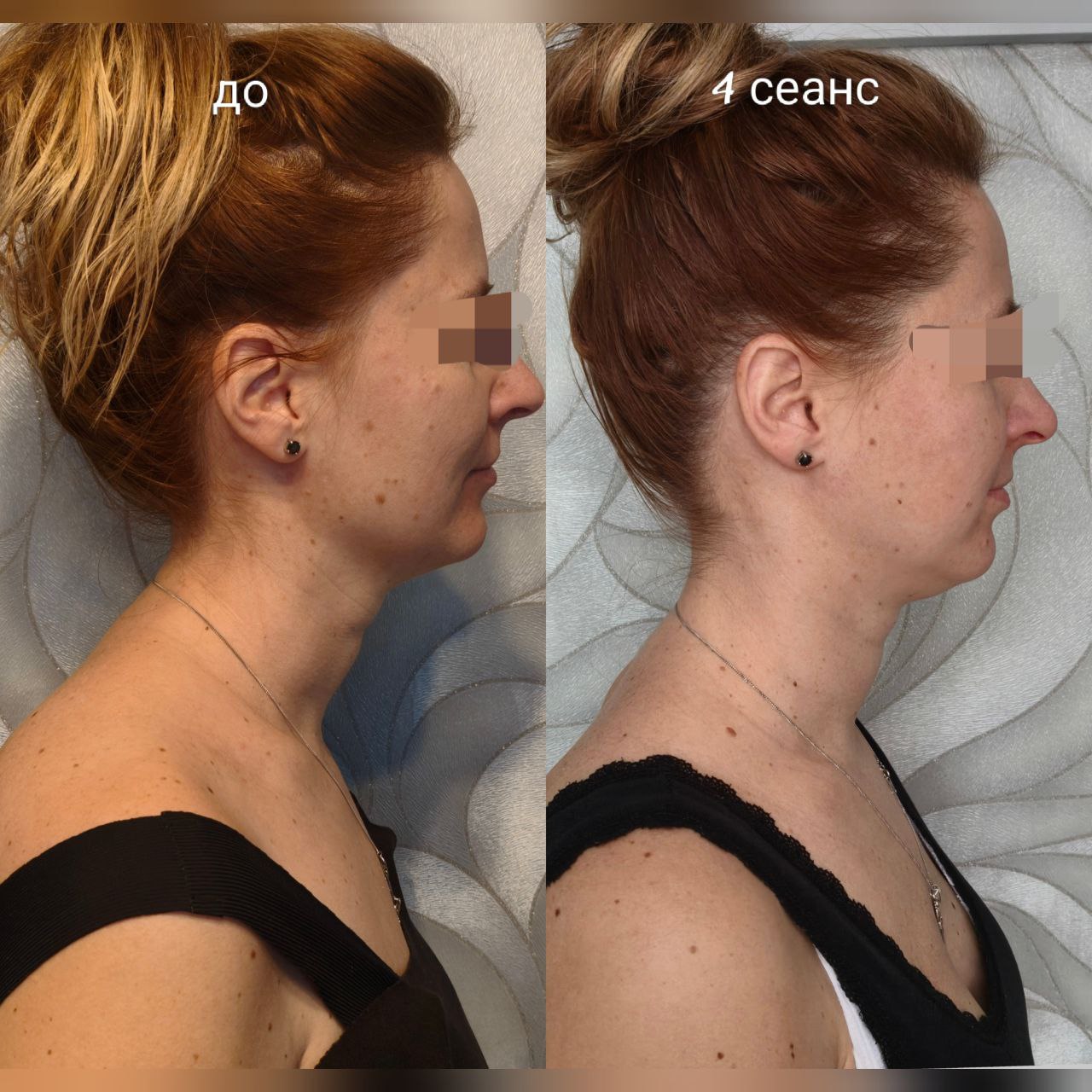 Лифтинг без инъекций