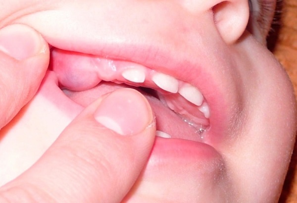Помощь при прорезывании зубов