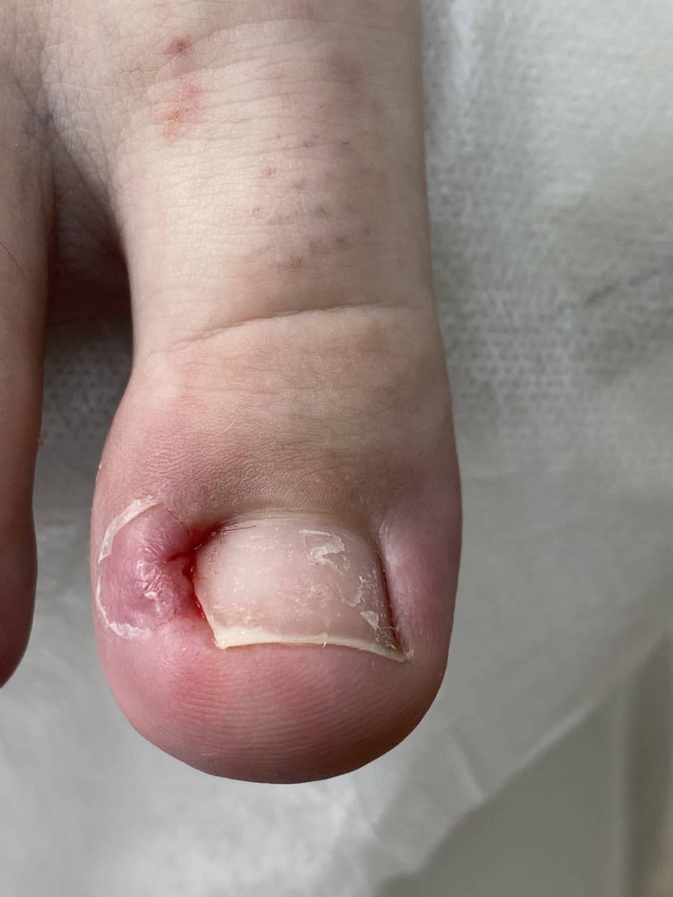 Обработка вросшего ногтя