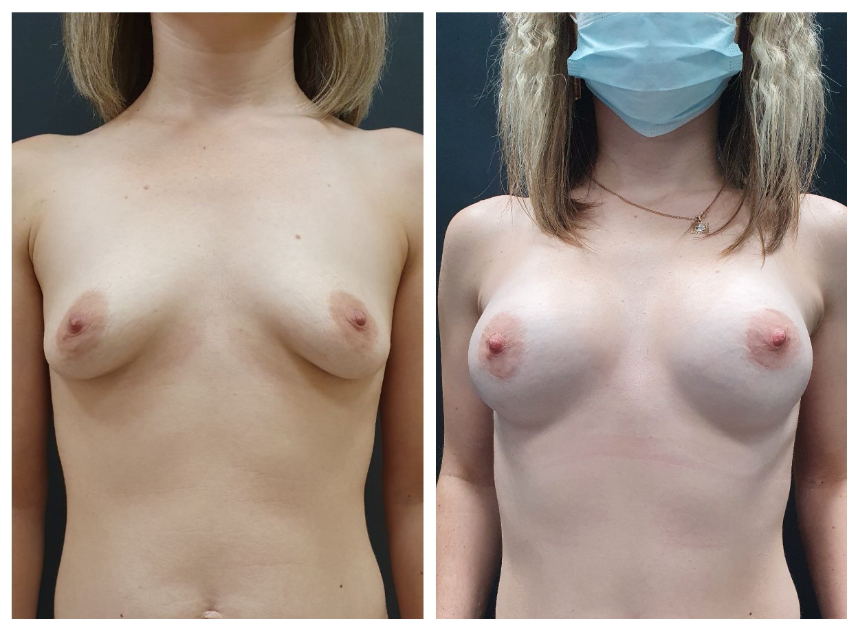 удаление и восстановление груди в одну операцию фото 96