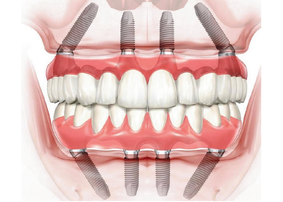 All-on-4 Teeth-in-a-Day ™ - Dental Implants - Dr. Antipov