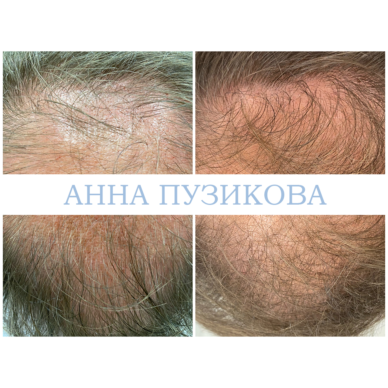 Результат лечения выпадения волос: повышение густоты, укрепление корней и улучшение состояния кожи головы — Прадус СПб.