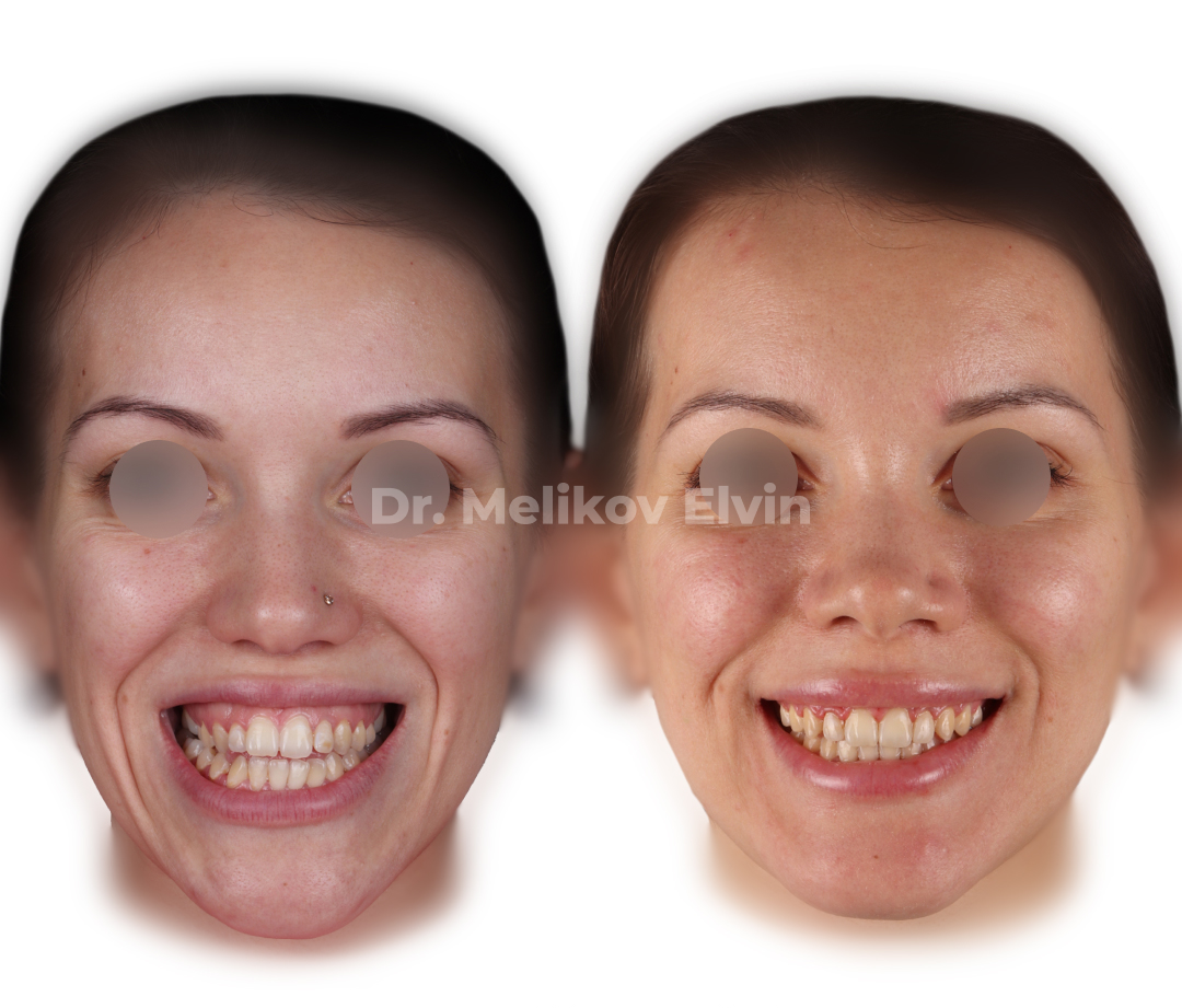 Фотографии до и после ортогнатической операции.