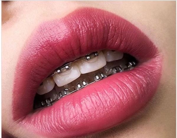 брекеты в Чебоксарах