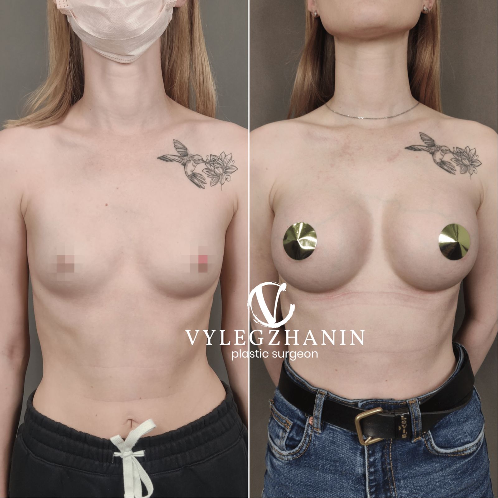 удаление и восстановление груди в одну операцию фото 99