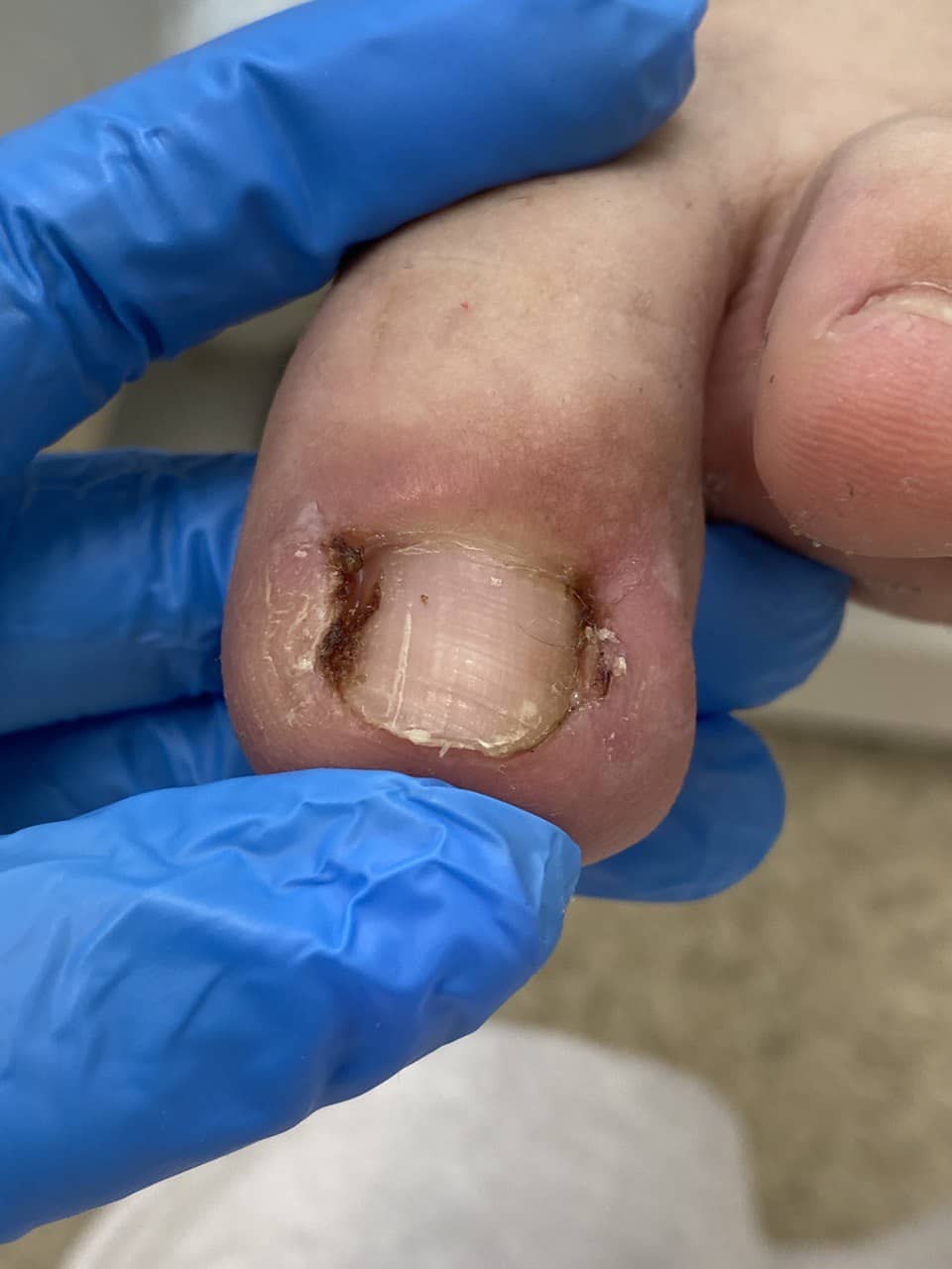 обработка пальцев стоп