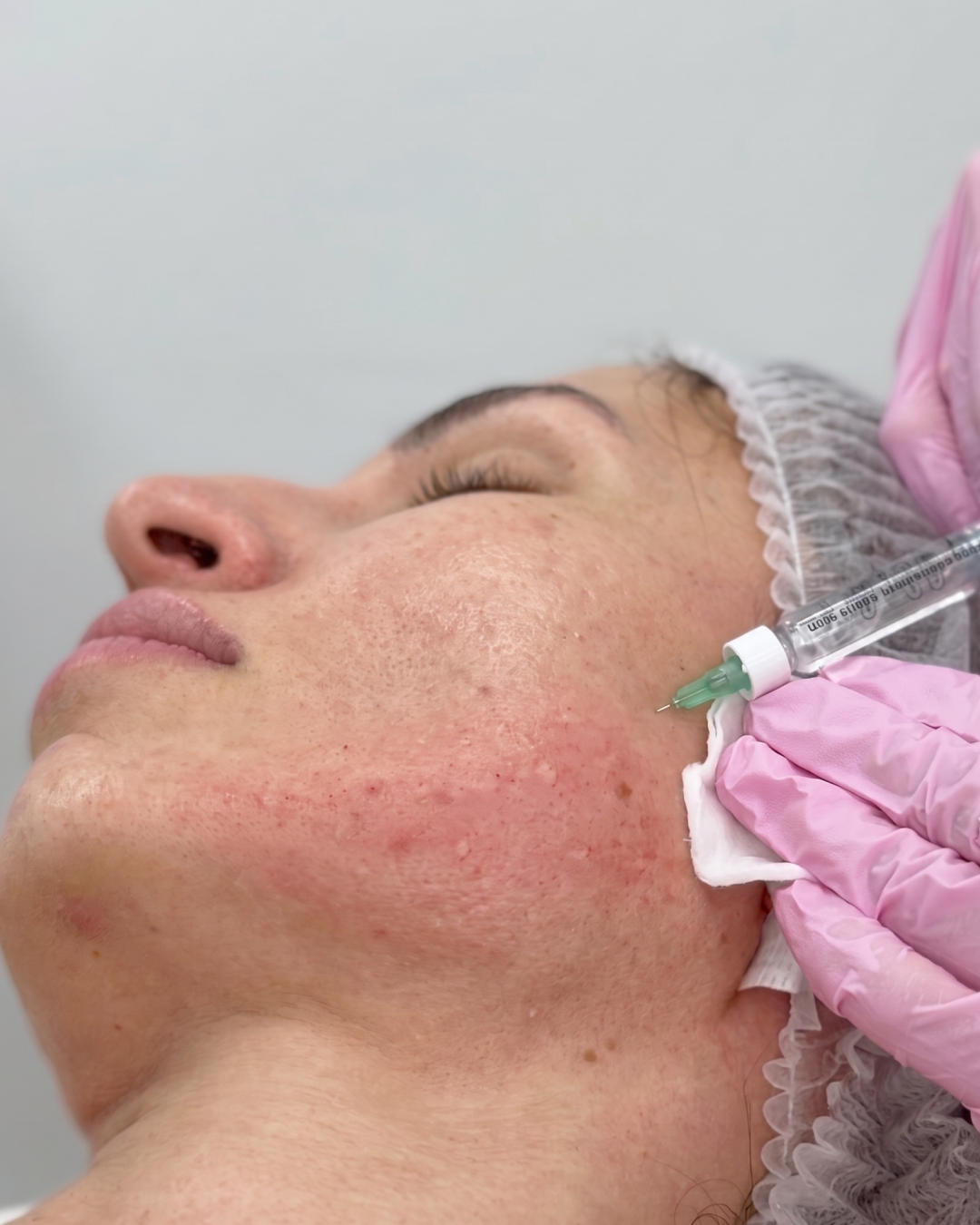 Микроинъекция препарата Novacutan SBio