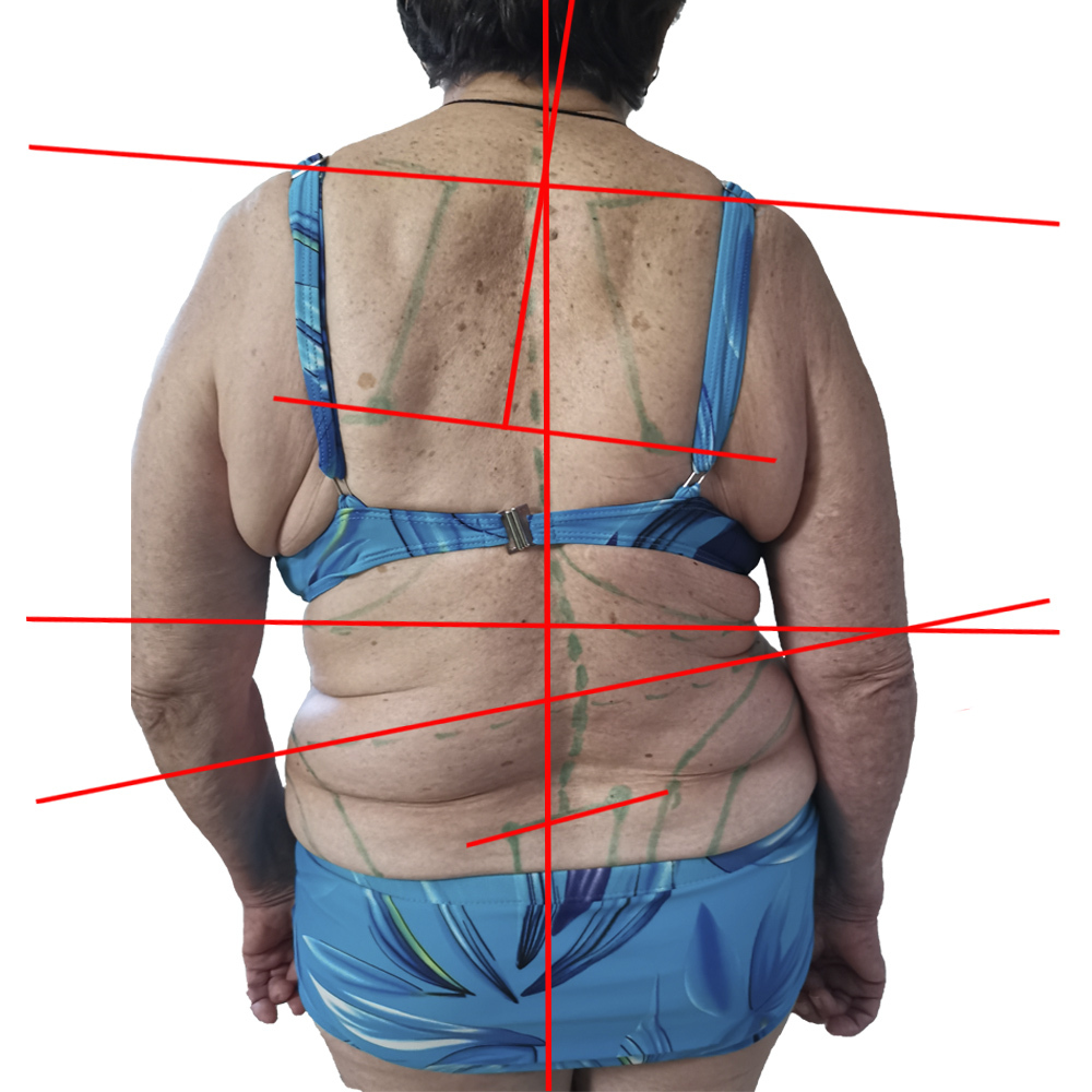 Фото с изображением всех перекосов с нанесением линий асимметрий на теле.
