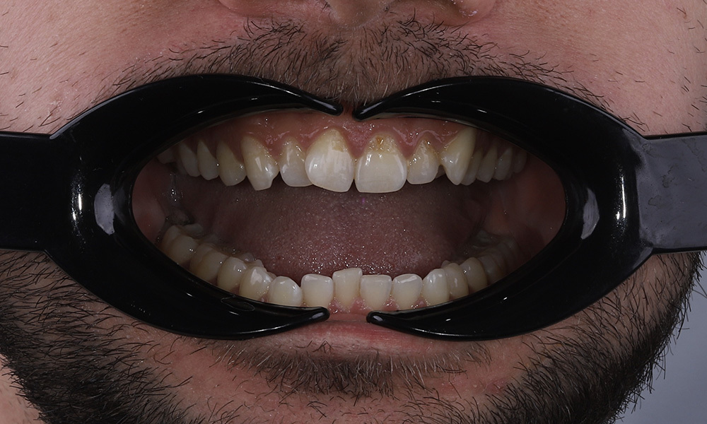 Коррекция прикуса с устранением скученности зубов и смещения нижней челюсти через гнатологическое и ортодонтическое лечение