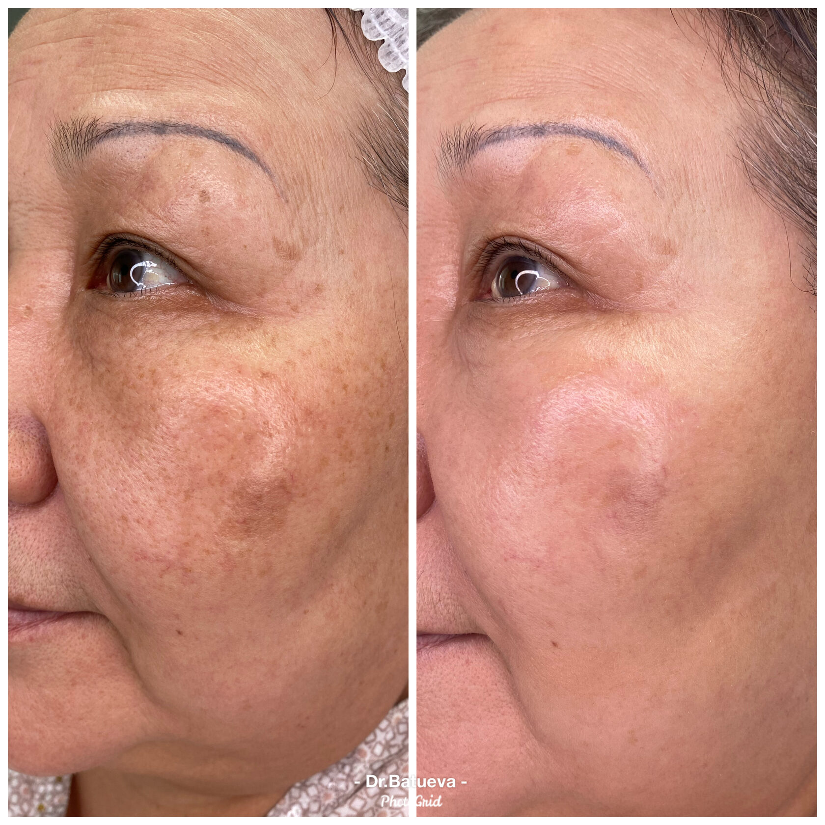 Пигментные пятна хлоазма. Избавиться от пигментации на лице. Пигментные пятна лентиго. Элос пигментацию лазером. Гиперпигментация на лице.